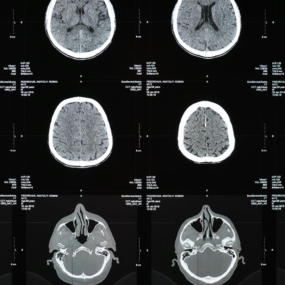 CT Scan